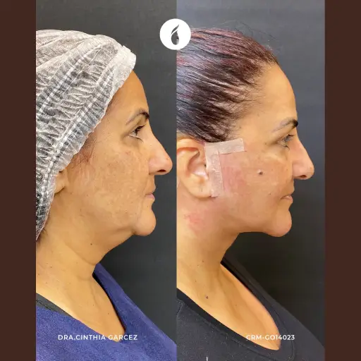 Antes e Depois do Procedimento de Lipo de Papada em Goiânia