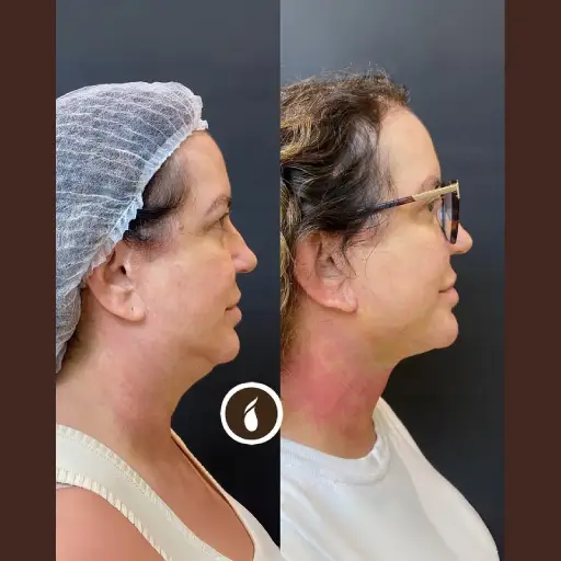 Antes e Depois do Procedimento de Lipo de Papada em Goiânia