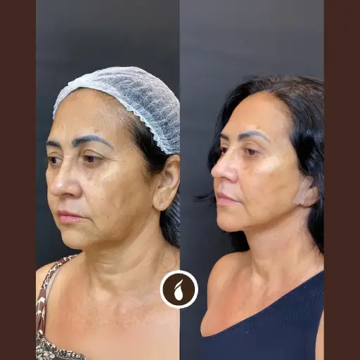 Antes e Depois do Procedimento de Lipo de Papada em Goiânia