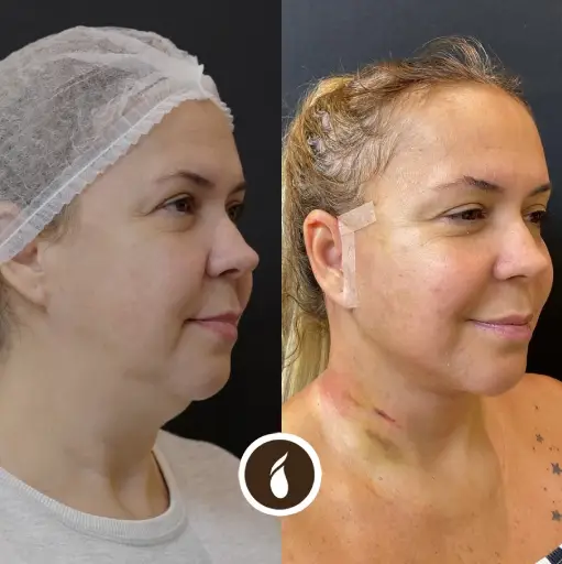 Antes e Depois do Procedimento de Lipo de Papada em Goiânia