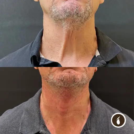 Antes e Depois do Procedimento de Lipo de Papada em Goiânia