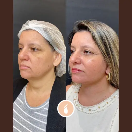 Antes e Depois do Procedimento de Lipo de Papada em Goiânia