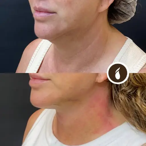 Antes e Depois do Procedimento de Lipo de Papada em Goiânia