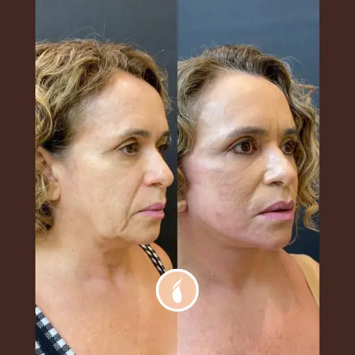 Antes e Depois do Procedimento de Lipo de Papada em Goiânia