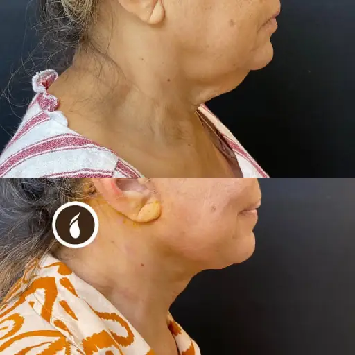 Antes e Depois do Procedimento de Lipo de Papada em Goiânia