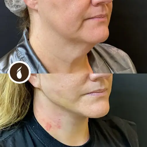 Antes e Depois do Procedimento de Lipo de Papada em Goiânia